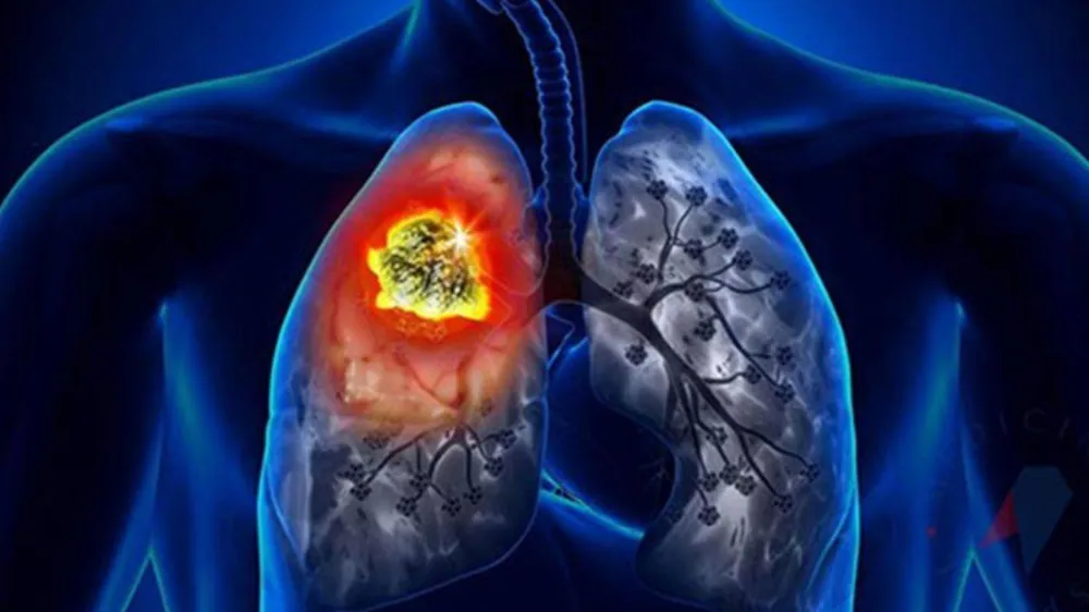Akciğer kanserinin ilk belirtisi nedir? Akciğer kanseri belirtileri