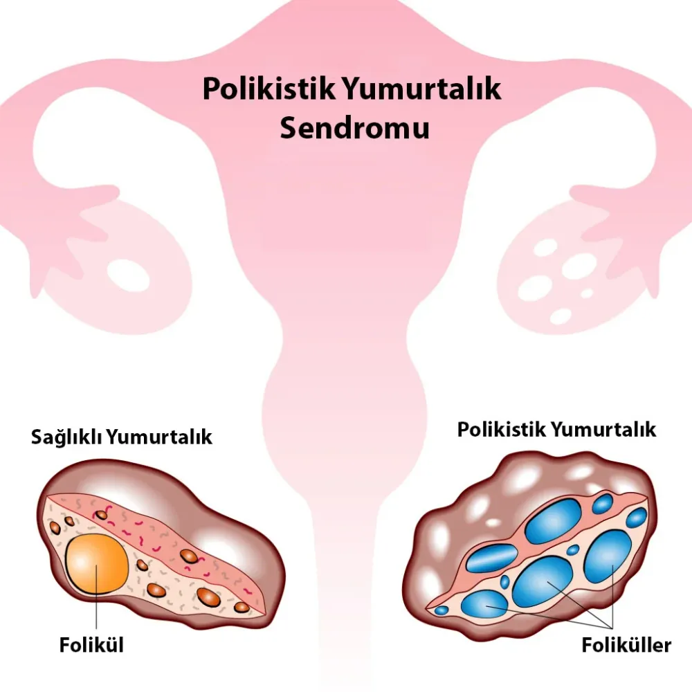 Polikistik Over Sendromu Nedir? PCOS Belirtileri Nelerdir?