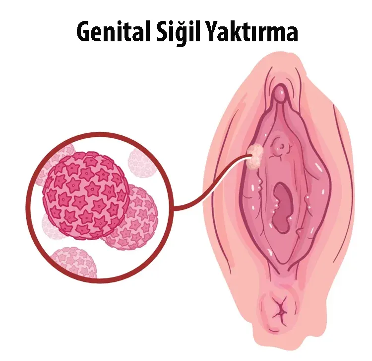 Siğil Yaktırma Nedir? Genital Siğil Yaktırma Nasıl Yapılır?