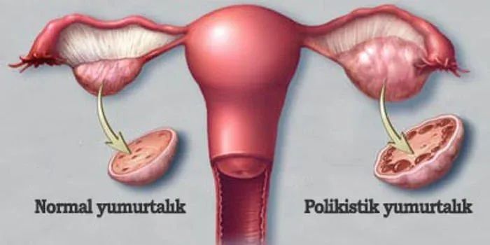 Polikistik Over Sendromu Nedir? PCOS Belirtileri Nelerdir?